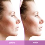 differin gel acne scar spot treatment for face resurfacing scar gel gentle skin care for acne prone sensitive skin 1 oz 1 2